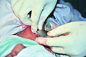 pacemaker-1