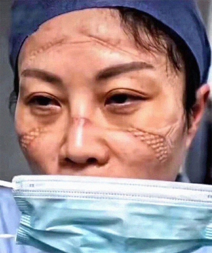 करोनाचा संसर्ग झालेल्या रुग्णांची काळजी घेतल्यानंतर डॉक्टरचा झालेला चेहरा. (Photo credit- PDChina)