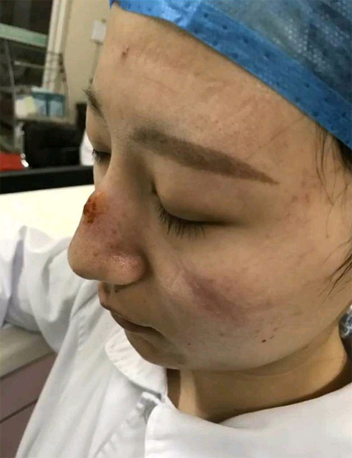 नर्सने १२ तास मास्क घालून काम केल्याने तिच्या चेहऱ्यावर ज्या ठिकाणी मास्क लावले होते तेथे वळ दिसत आहेत. (Photo credit- PDChina)