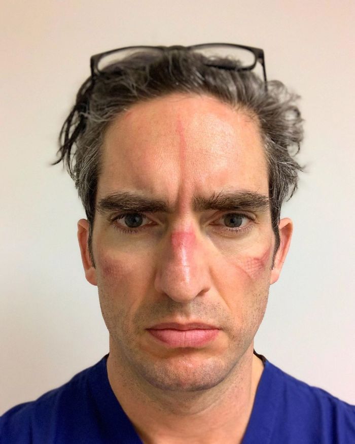 ११ तास काम केल्यानंतर डॉक्टरचा चेहरा. (Photo credit- rowing.nurse)