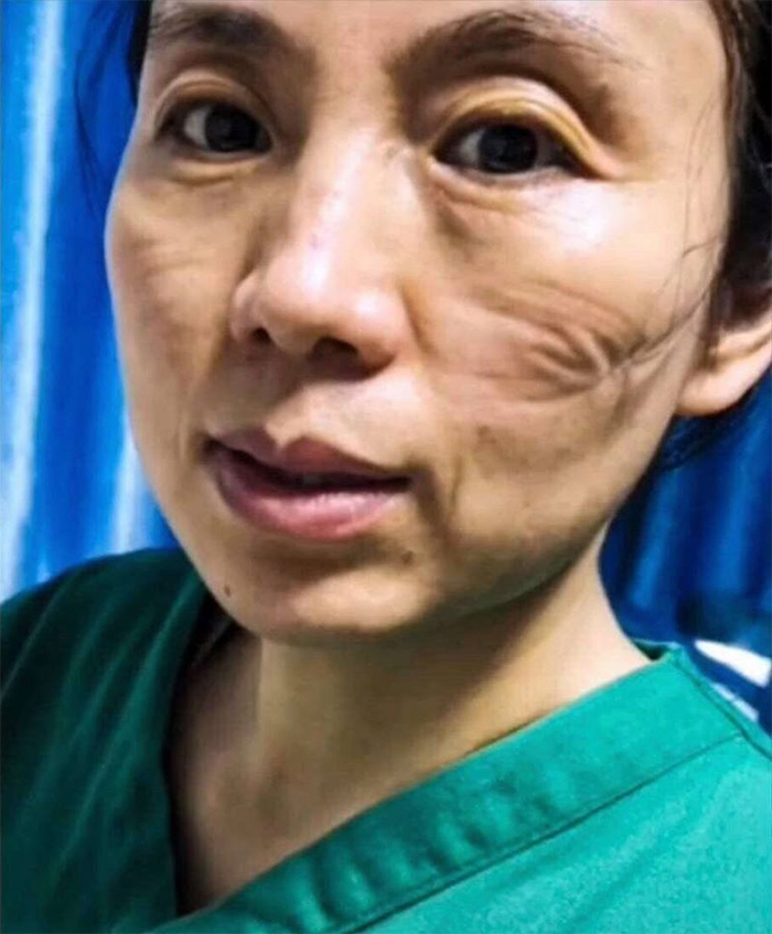 करोनाच्या रुग्णांची काळजी घेतल्यानंतर नर्सचा फोटो सोशल मीडियावर व्हायरल झाला आहे. (Photo credit- PDChina)