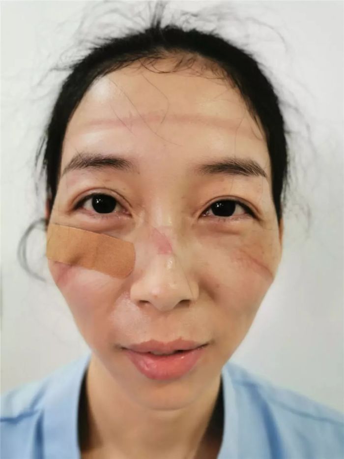 आठ तासांची शिफ्ट संपल्यावर नर्सने चेहऱ्यावरील मास्क काढला. (Photo credit- PDChina)