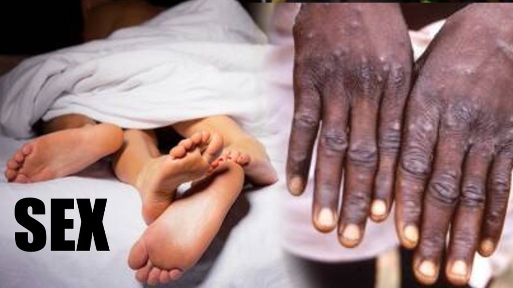 Can Monkeypox spread through sex