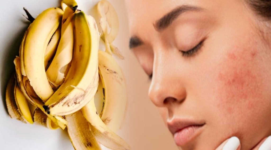 Banana Peel For Acne