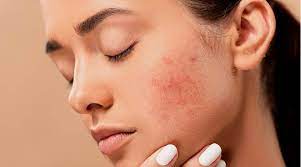 gram flour and rose water face pack gives 'these' amazing benefits