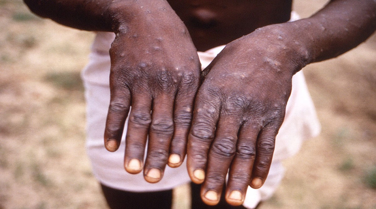 Know the do's and don'ts amid rising cases of monkeypox in India