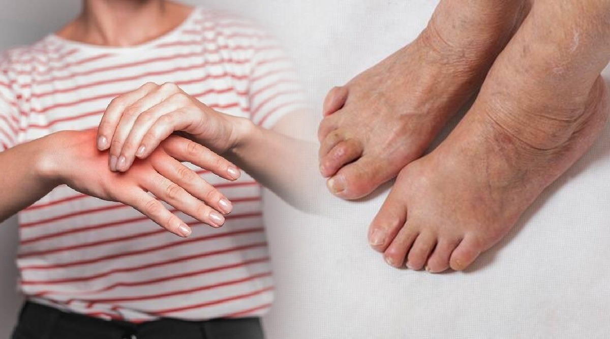 Are your hands and feet swelling? Don't ignore the mistake; Try these