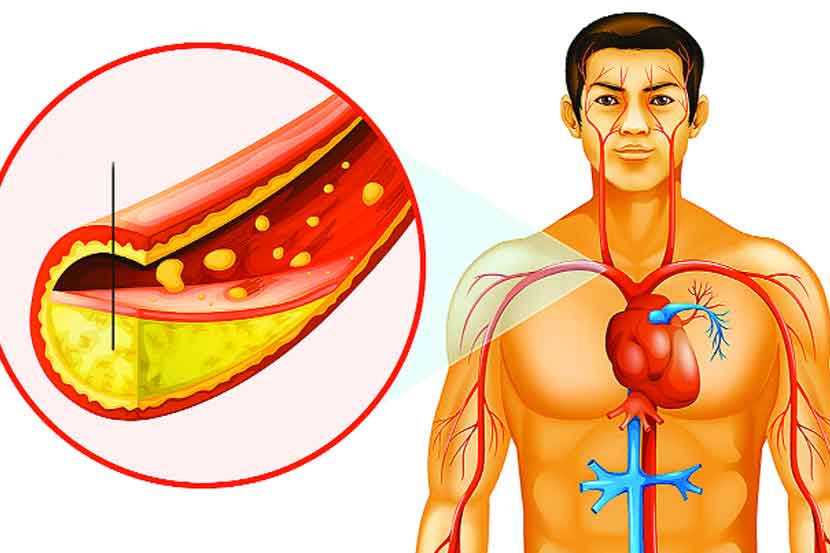  3 symptoms seen in the hand due to High Cholesterol