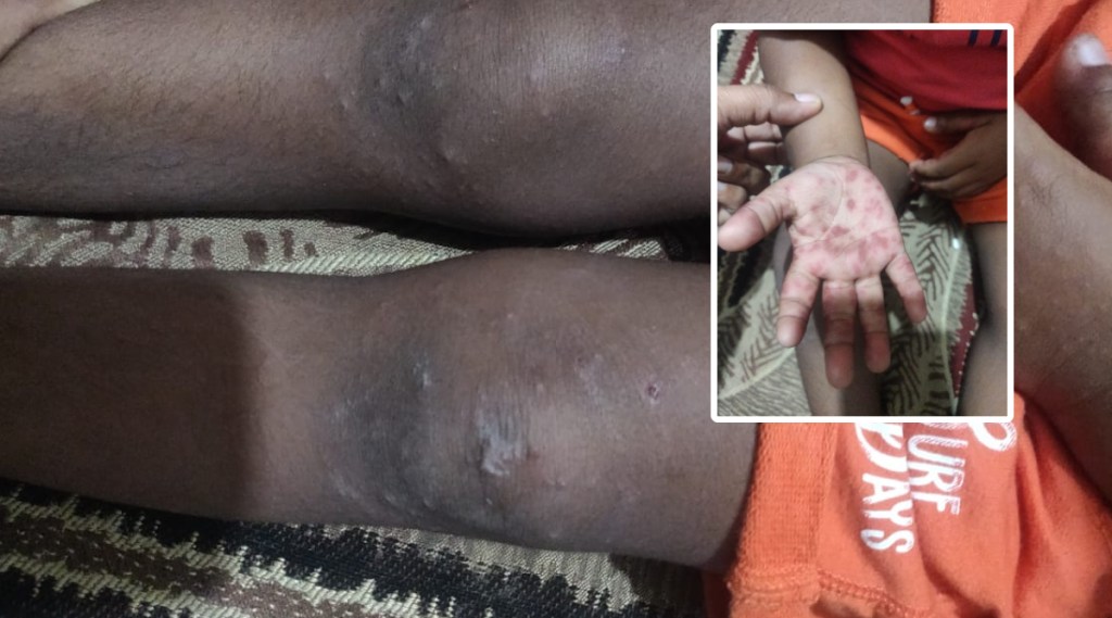 Chickenpox like rash on hands feet mouth in children in Nagpur