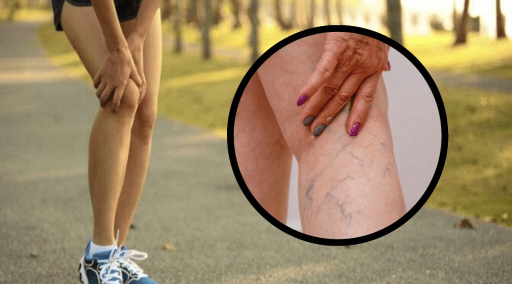 Varicose veins Swelling in feet blood vessels turn blue green how to cure impure blood Ayurvedic Treatment