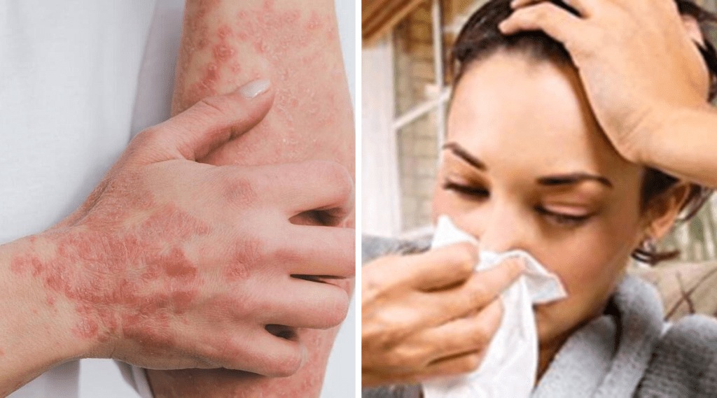 WHO Reports Fungal Infections List Types Of Skin Infection Symptoms Causes Precautions who has more threat