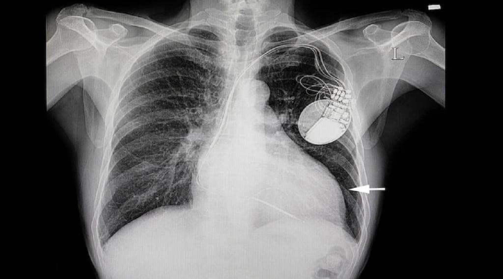 pulmonary edema causes