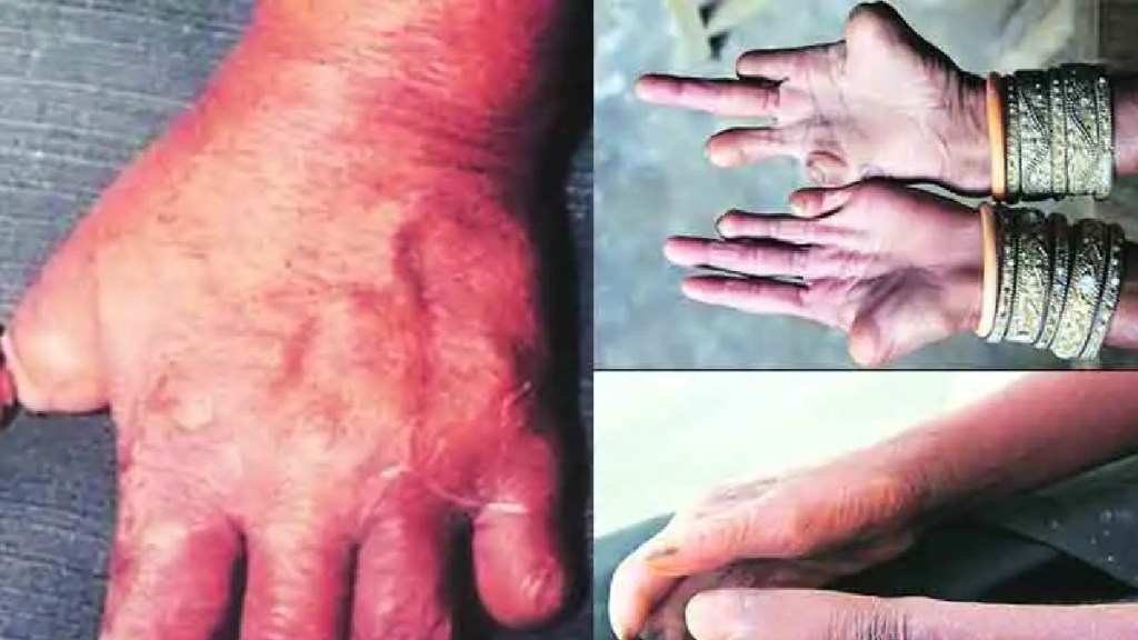 Eradication of leprosy New infections in children under 14 years of age pune