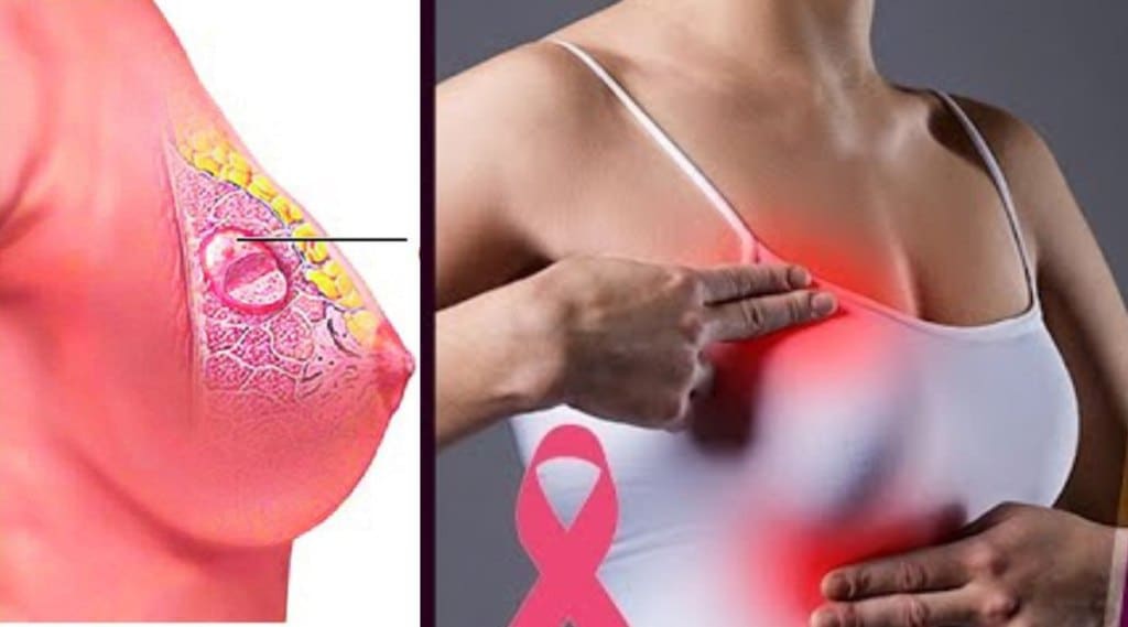 breast cancer