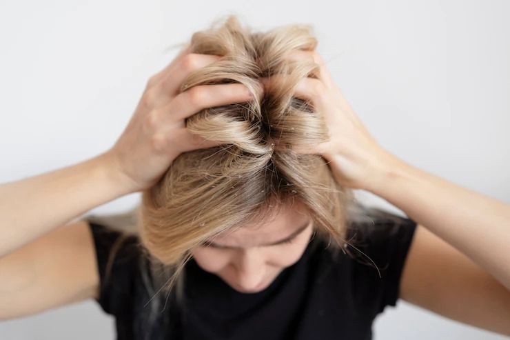 Dandruff and hair fall problem