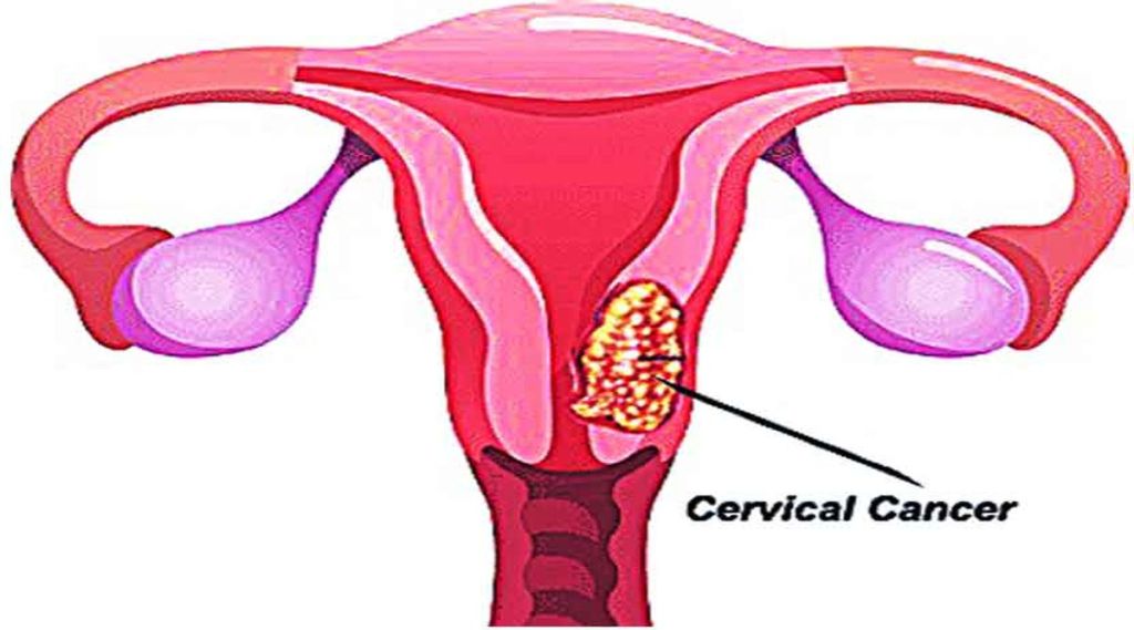 cervical cancer