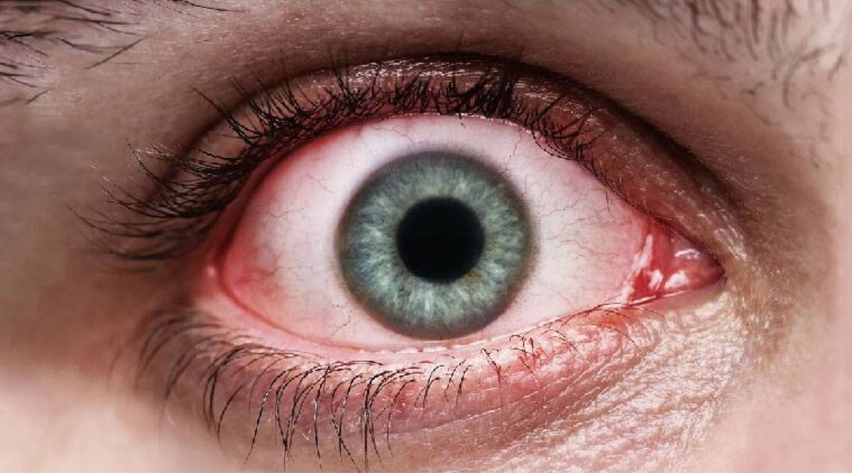 Red Eyes Cause डोळे लाल होतात, याला कारणीभूत आहेत या गोष्टी, तुमच्यात