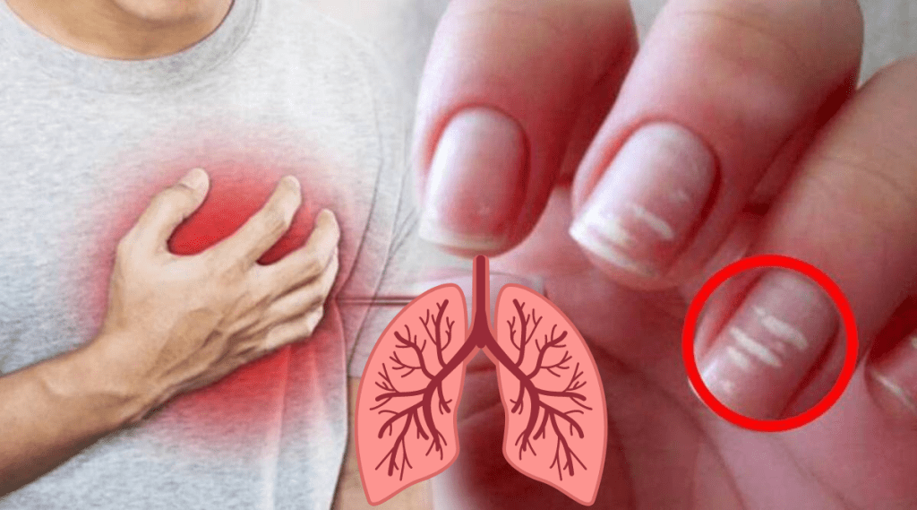 white-spots-on-nails-are-not-because-of-calcium-deficiency-heart-and