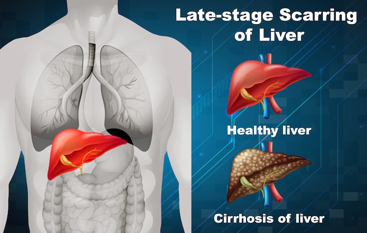 healthy liver diet 