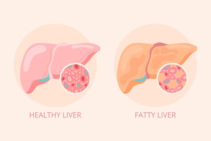 healthy liver diet 