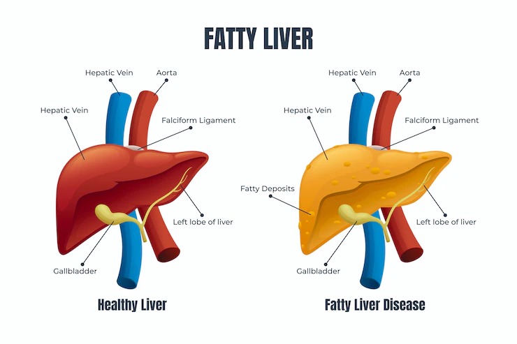 healthy liver diet 