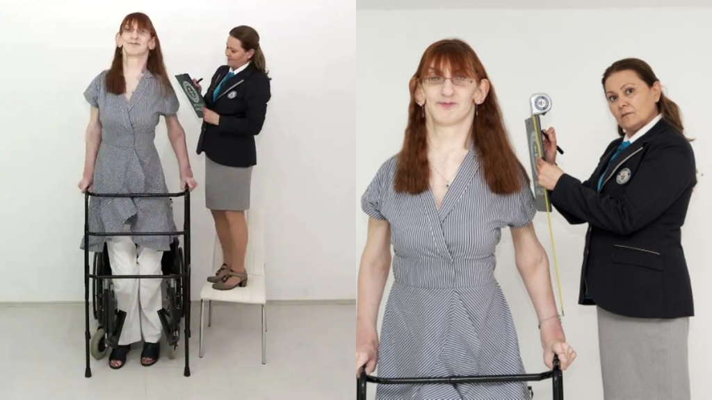 Extreme Rare Syndrome That Increases Height Tallest Women On The Earth Shares Shocking Experience