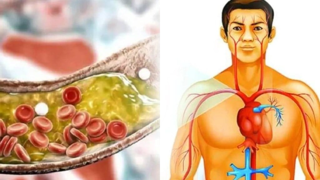 High cholsterol causes