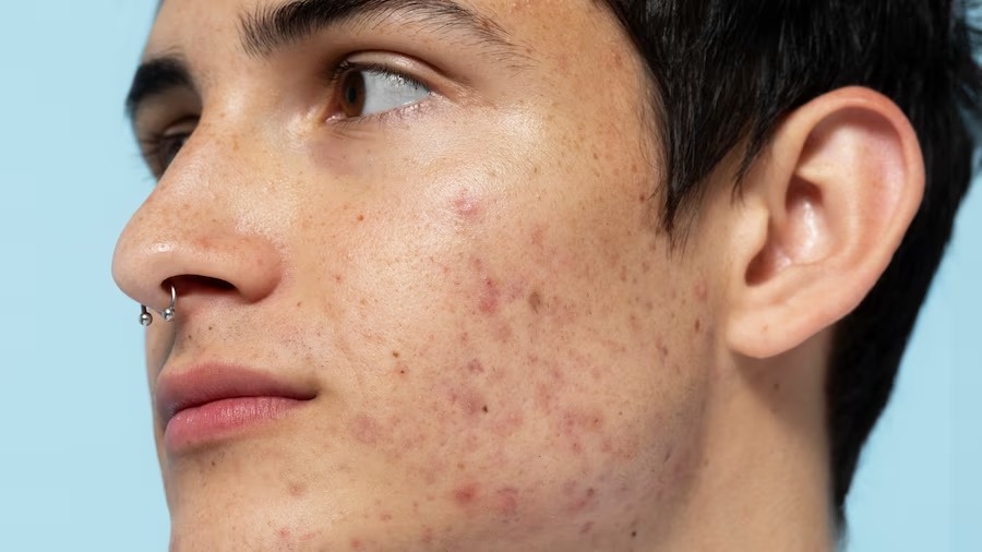 skin care pimple problem