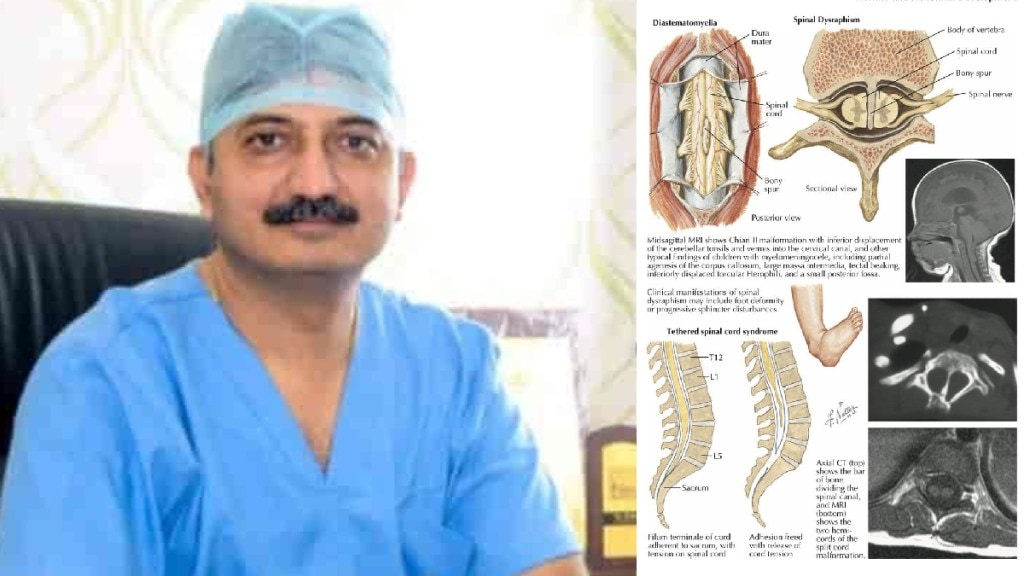 spinal cod surgery