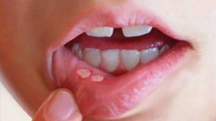 Ayurvedic Home Remedies For Mouth Ulcer