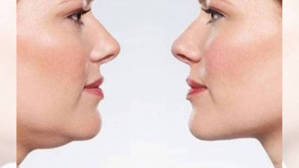 how to reduce neck fat