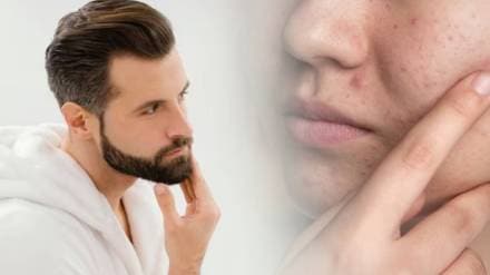 Beard bacteria and skin reactions