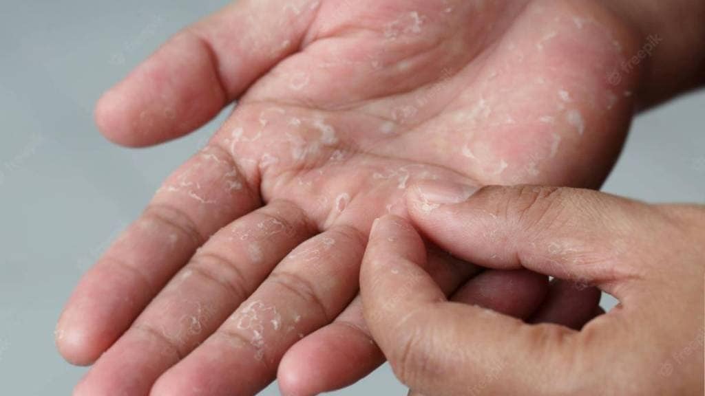 skin peeling causes home remedies