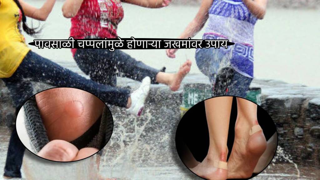 Monsoon Footwear Shoe Bite Remedies To Save Money And Pain From Wounds Burning Choose Sandals Jugadu Tips