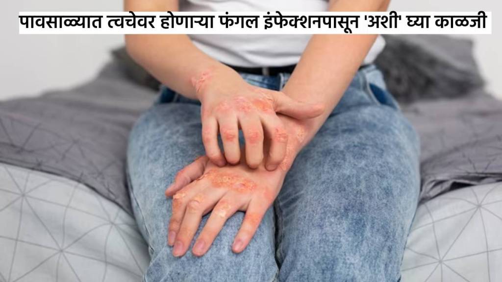 monsoon skin care tips ungal infection