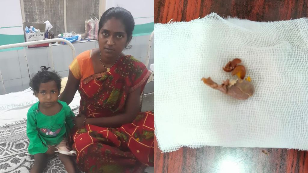 jambhul seed stuck in girls oesophagus