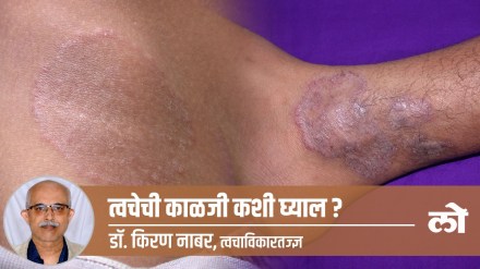 skin disease, health, ringworm