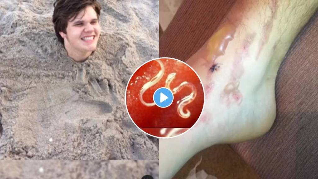 This Teen Got Hookworms After His Friends Buried Him In The Sand At The Beach video viral on social media