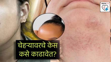 Facial Hair Removal Why Do Women get Hair On Face Like Beard but Same Time Hair Line Goes Back From Forehead PCOS Cure