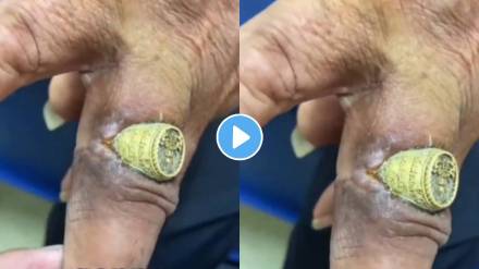 tight ring entered inside man finger by cutting skin watch viral video how to get a ring off