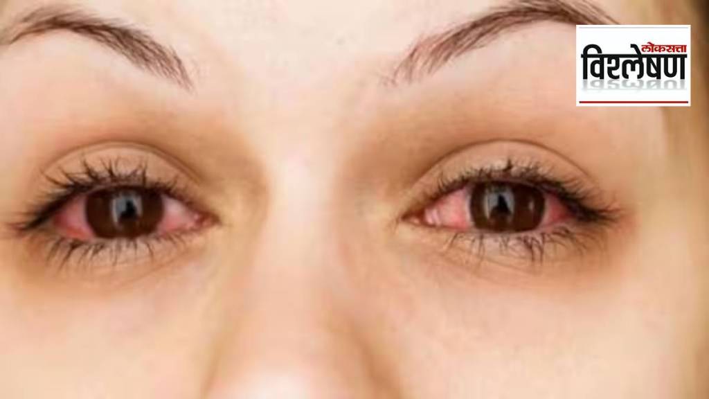 eye Conjunctivitis