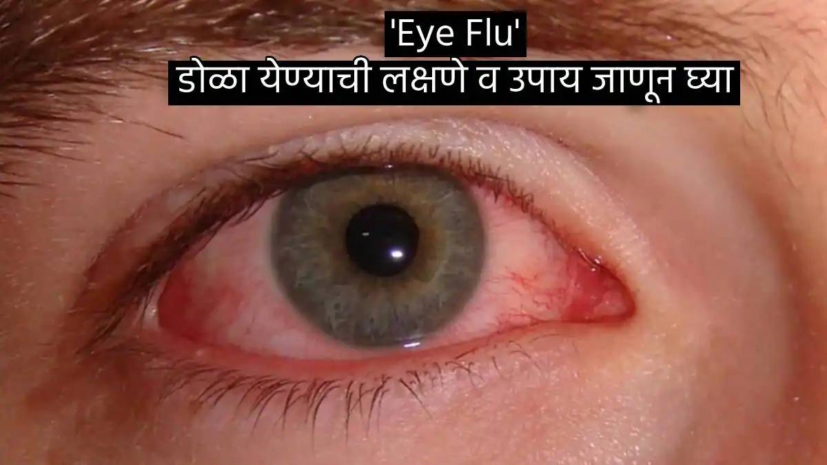 Dole Yene Eye Flu Signs And Home Remedies How To Keep Eyes Clean And Safe During Conjunctivitis Spread In Maharashtra 