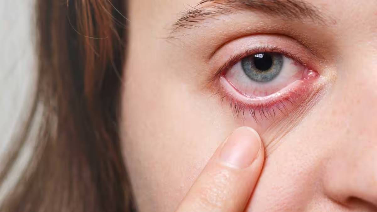 Dole Yene Eye Flu Signs And Home Remedies How To Keep Eyes Clean And Safe During Conjunctivitis Spread In Maharashtra 