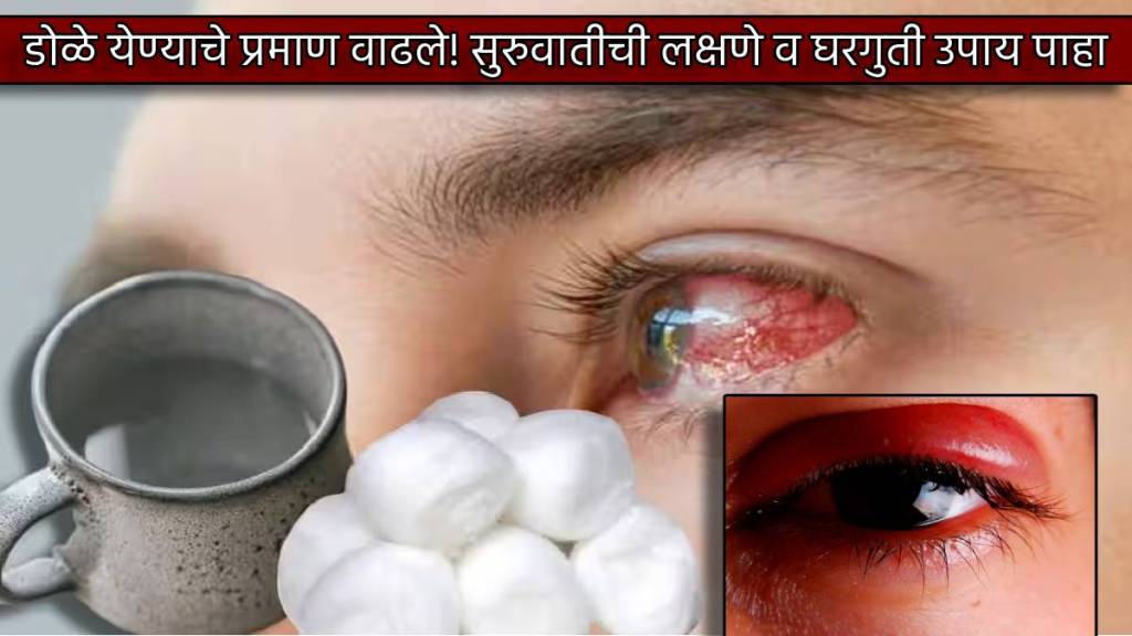 Dole Yene Conjunctivitis First Signs Home Treatment Which Eyedrop Should Be Used To Reduce Eyes Burning Things Keep Mind