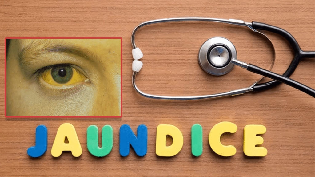 jaundice risk increased nagpur