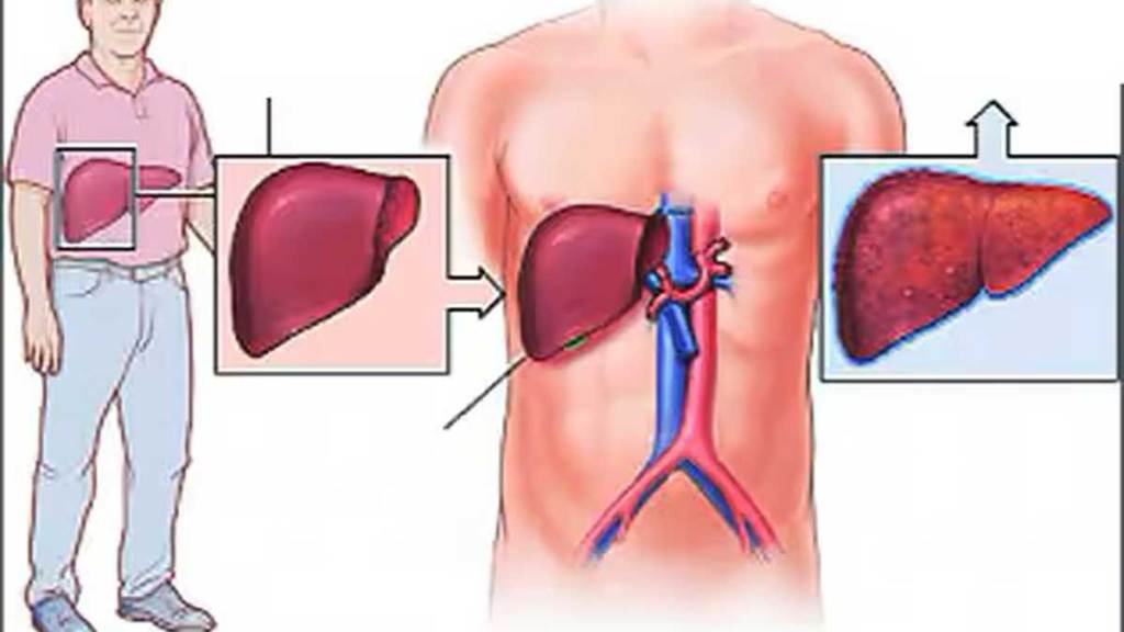 Liver transplants with blood group mismatched