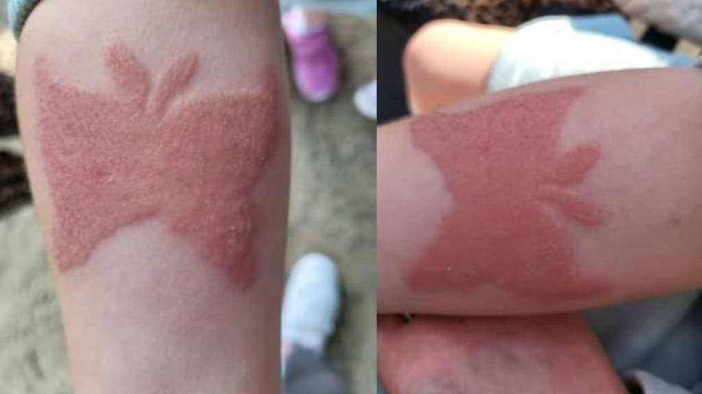 A seven year old girl developed an allergic reaction after a week of getting a henna tattoo