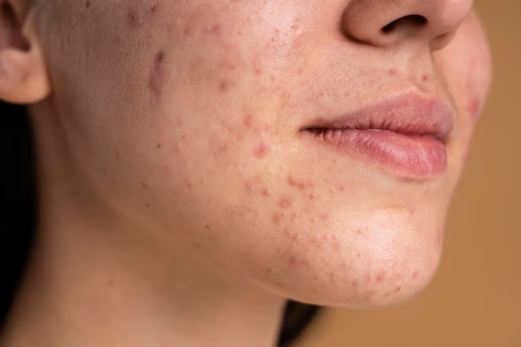 Skin Care Tips Stubborn acne scars