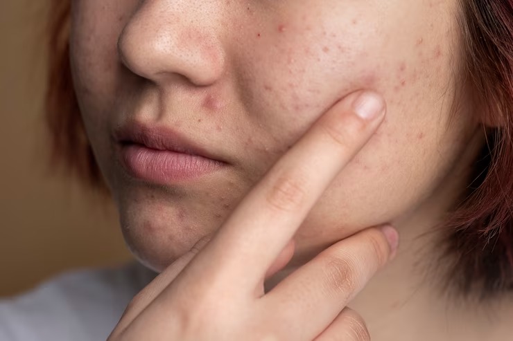 Skin Care Tips Stubborn acne scars