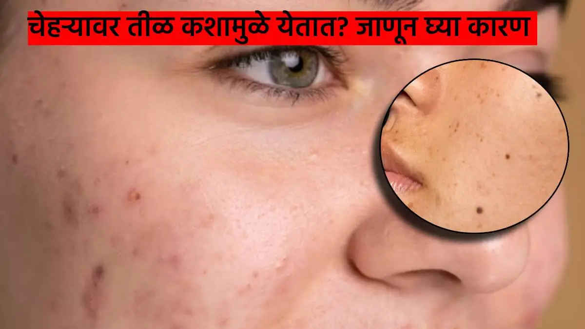 moles-on-face-reason-know-about-can-you-remove-moles-permanently